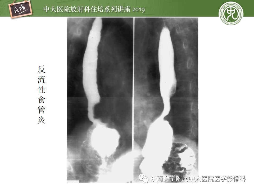 【PPT】食管常见疾病的诊断和鉴别诊断