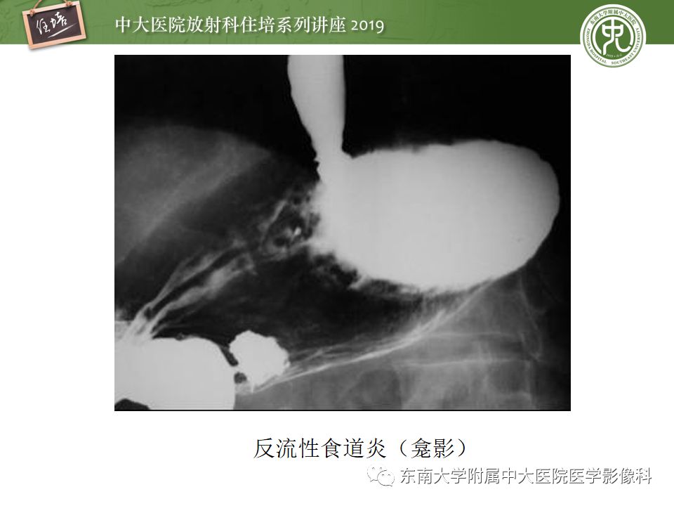 【PPT】食管常见疾病的诊断和鉴别诊断