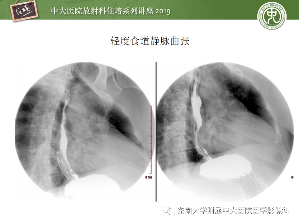 【PPT】食管常见疾病的诊断和鉴别诊断