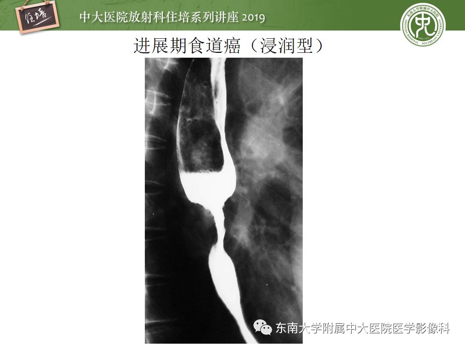 【PPT】食管常见疾病的诊断和鉴别诊断