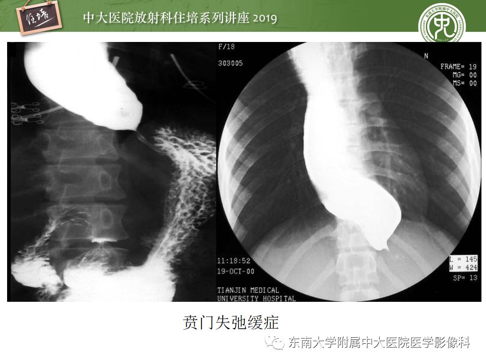 【PPT】食管常见疾病的诊断和鉴别诊断