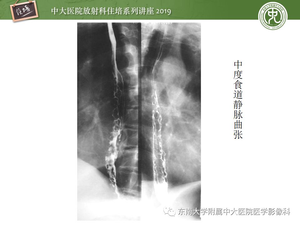 【PPT】食管常见疾病的诊断和鉴别诊断