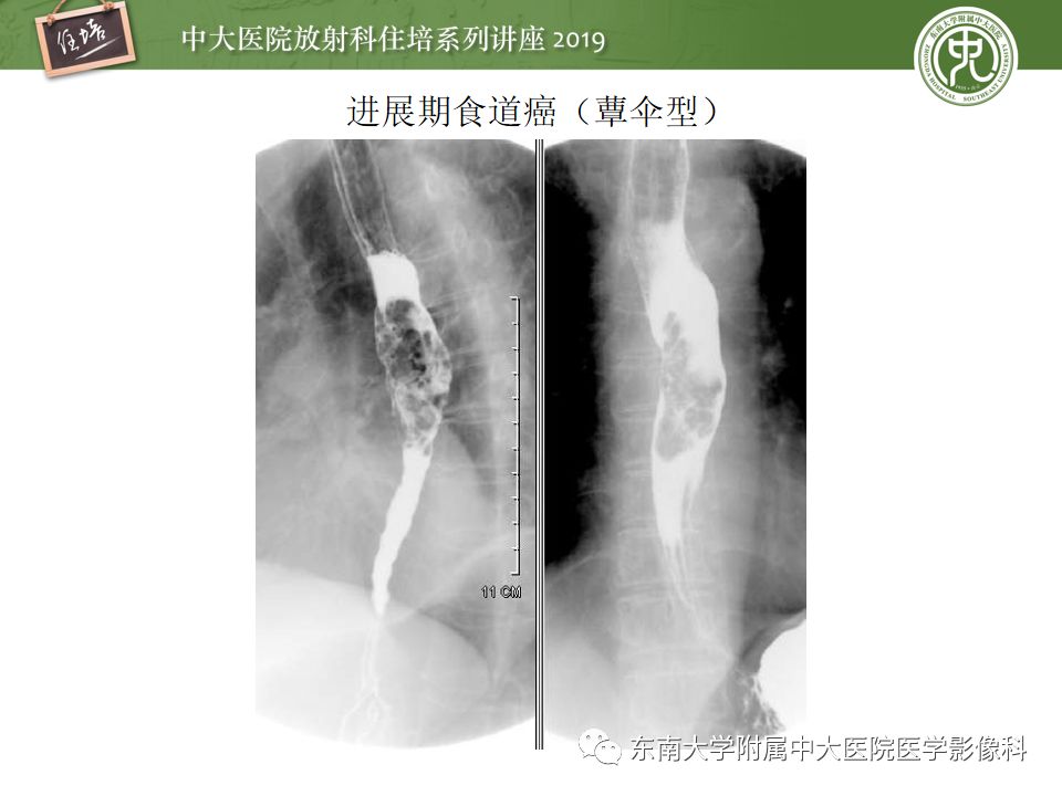 【PPT】食管常见疾病的诊断和鉴别诊断