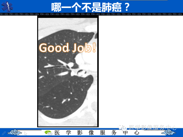 【PPT】肺癌的影像学鉴别诊断实例：哪些不是肺癌