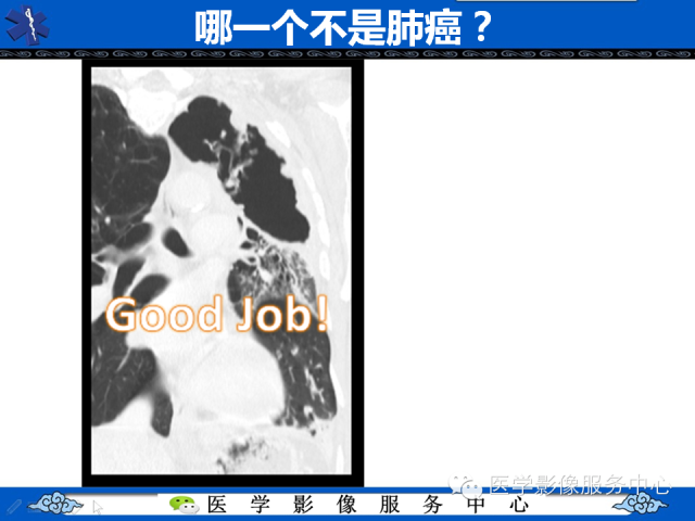 【PPT】肺癌的影像学鉴别诊断实例：哪些不是肺癌
