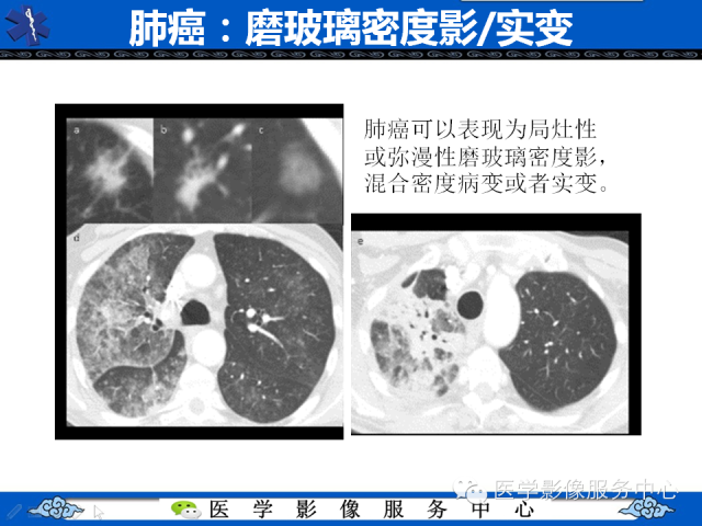 【PPT】肺癌的影像学鉴别诊断实例：哪些不是肺癌