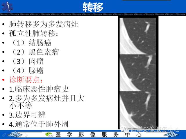 【PPT】肺癌的影像学鉴别诊断实例：哪些不是肺癌