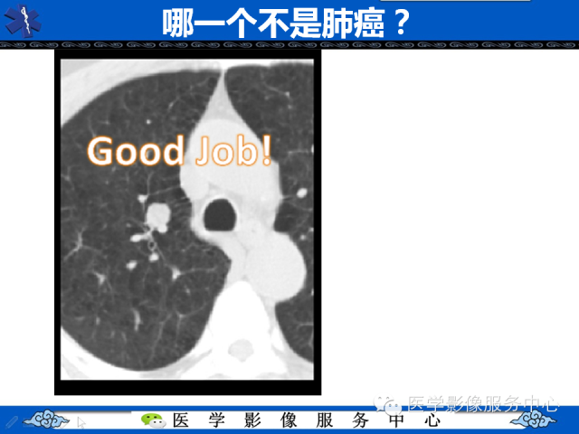 【PPT】肺癌的影像学鉴别诊断实例：哪些不是肺癌