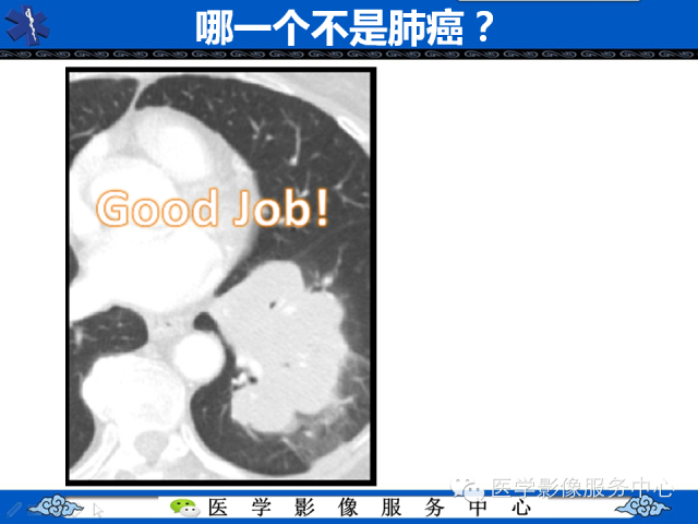 【PPT】肺癌的影像学鉴别诊断实例：哪些不是肺癌