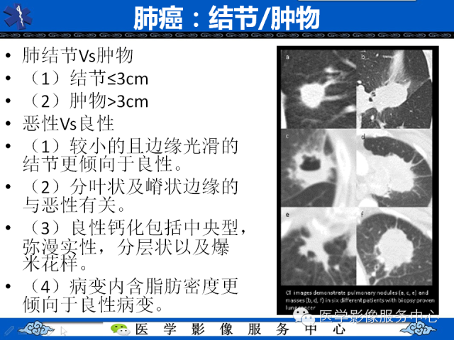 【PPT】肺癌的影像学鉴别诊断实例：哪些不是肺癌