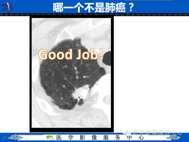 【PPT】肺癌的影像学鉴别诊断实例：哪些不是肺癌