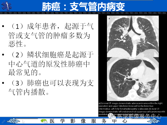 【PPT】肺癌的影像学鉴别诊断实例：哪些不是肺癌
