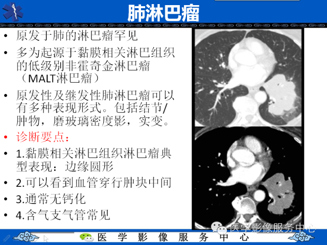 【PPT】肺癌的影像学鉴别诊断实例：哪些不是肺癌