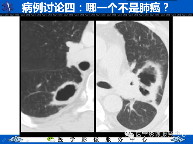 【PPT】肺癌的影像学鉴别诊断实例：哪些不是肺癌