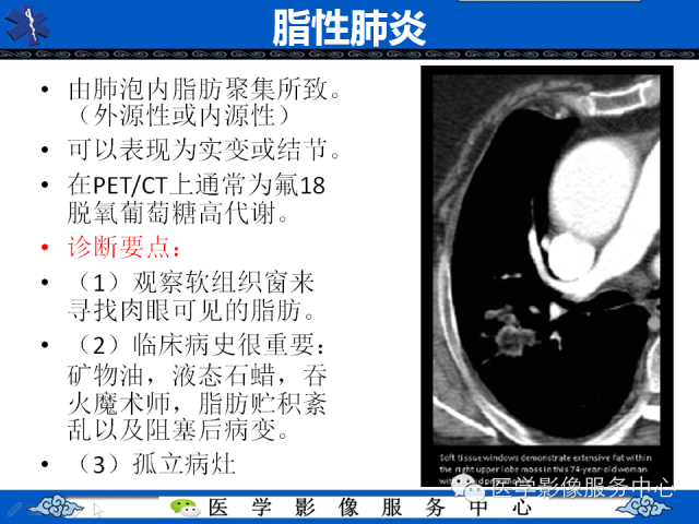 【PPT】肺癌的影像学鉴别诊断实例：哪些不是肺癌