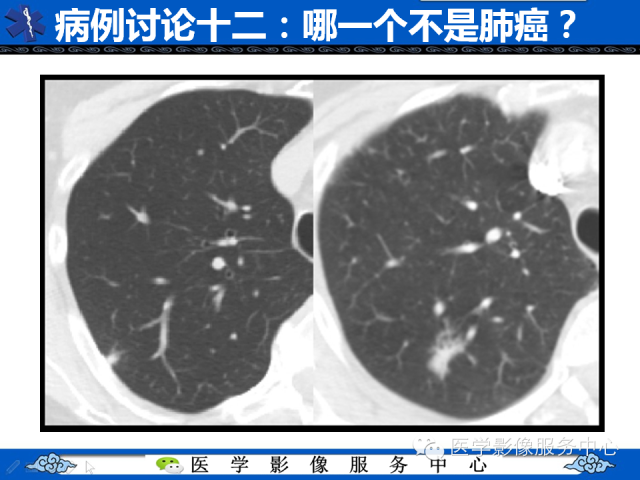 【PPT】肺癌的影像学鉴别诊断实例：哪些不是肺癌