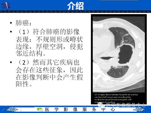 【PPT】肺癌的影像学鉴别诊断实例：哪些不是肺癌