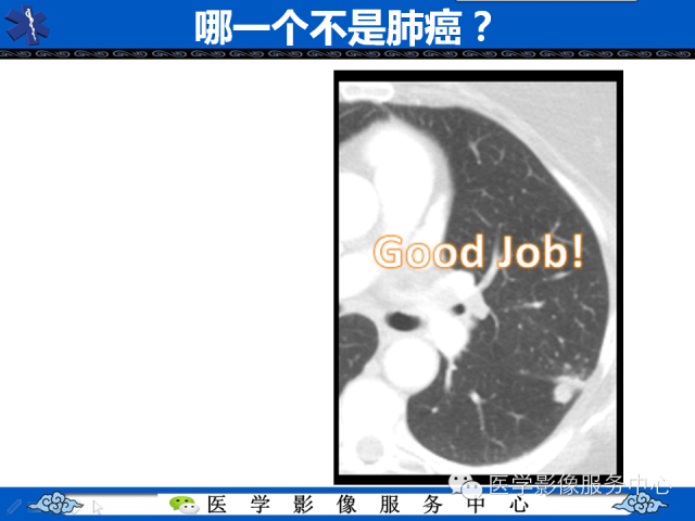 【PPT】肺癌的影像学鉴别诊断实例：哪些不是肺癌