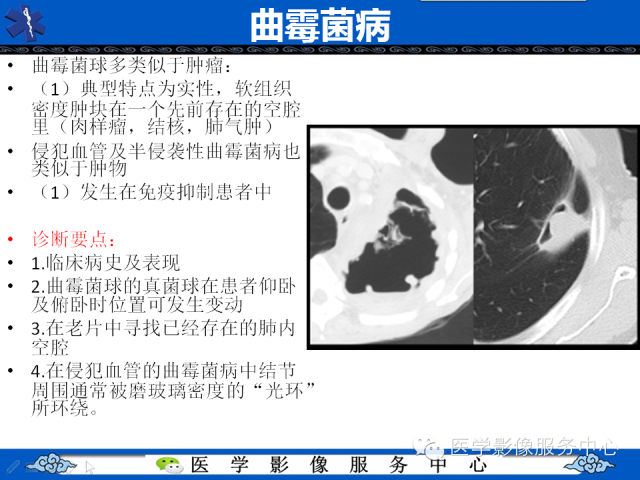 【PPT】肺癌的影像学鉴别诊断实例：哪些不是肺癌