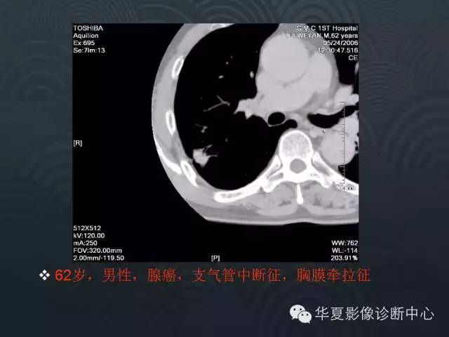 【PPT】小肺癌的影像表现及鉴别诊断