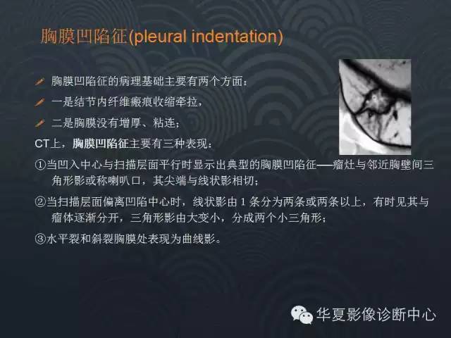 【PPT】小肺癌的影像表现及鉴别诊断