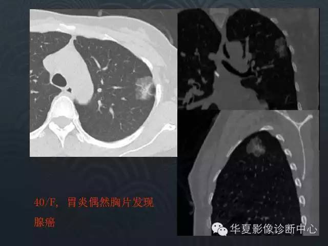 【PPT】小肺癌的影像表现及鉴别诊断