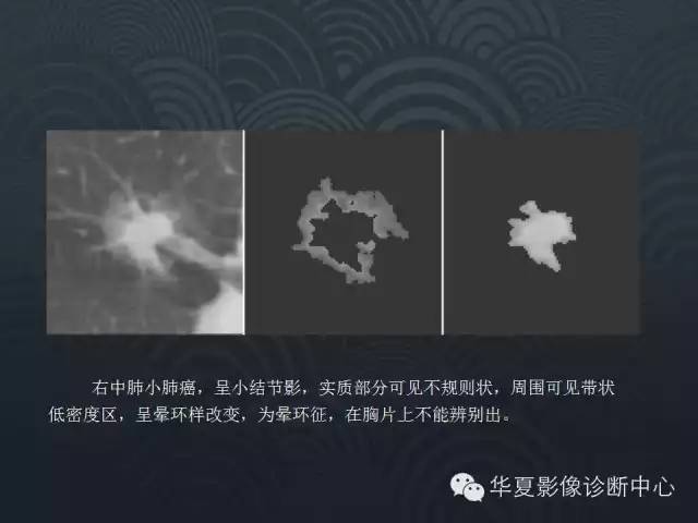 【PPT】小肺癌的影像表现及鉴别诊断