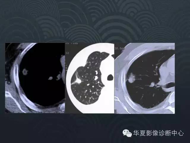 【PPT】小肺癌的影像表现及鉴别诊断