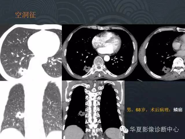 【PPT】小肺癌的影像表现及鉴别诊断