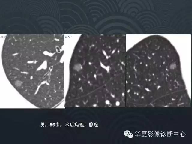 【PPT】小肺癌的影像表现及鉴别诊断