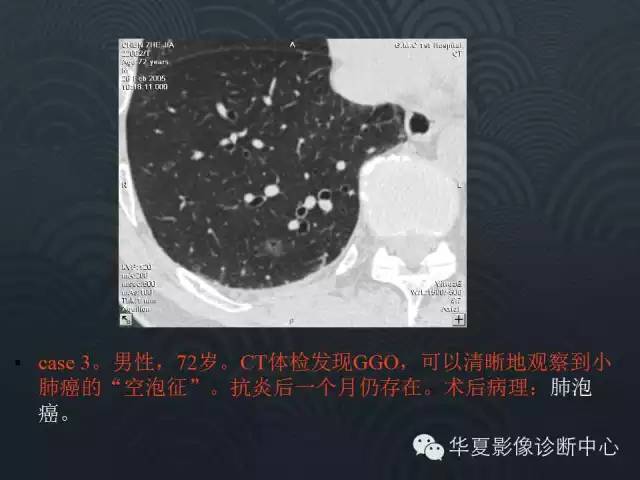 【PPT】小肺癌的影像表现及鉴别诊断