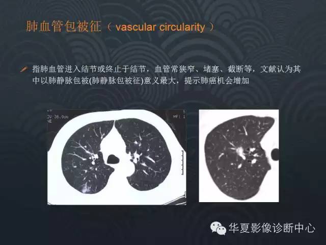 【PPT】小肺癌的影像表现及鉴别诊断