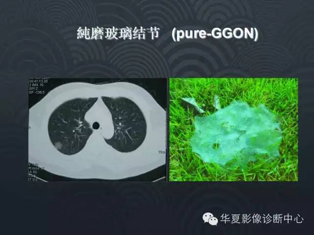 【PPT】小肺癌的影像表现及鉴别诊断