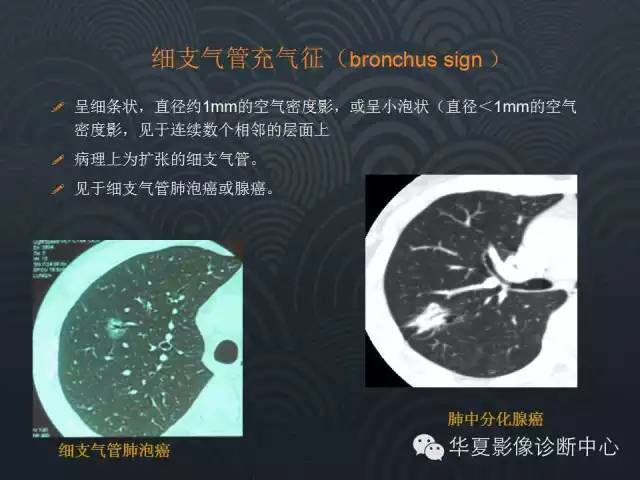 【PPT】小肺癌的影像表现及鉴别诊断