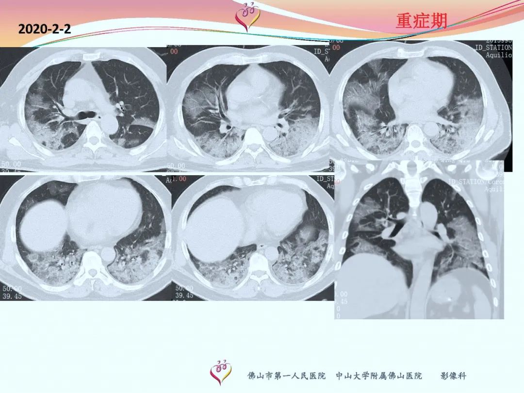【PPT】CT室对新型冠状病毒肺炎的应对策略及影像诊断分析