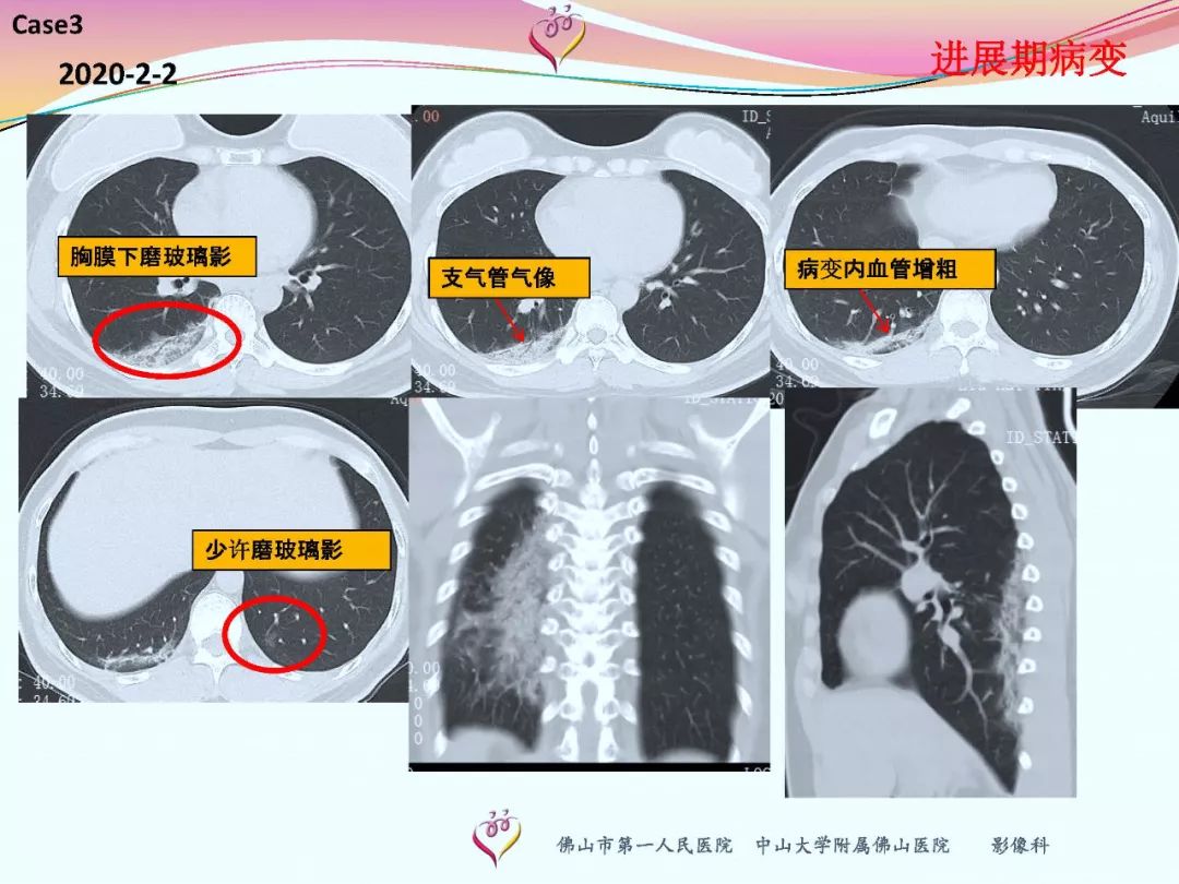 【PPT】CT室对新型冠状病毒肺炎的应对策略及影像诊断分析