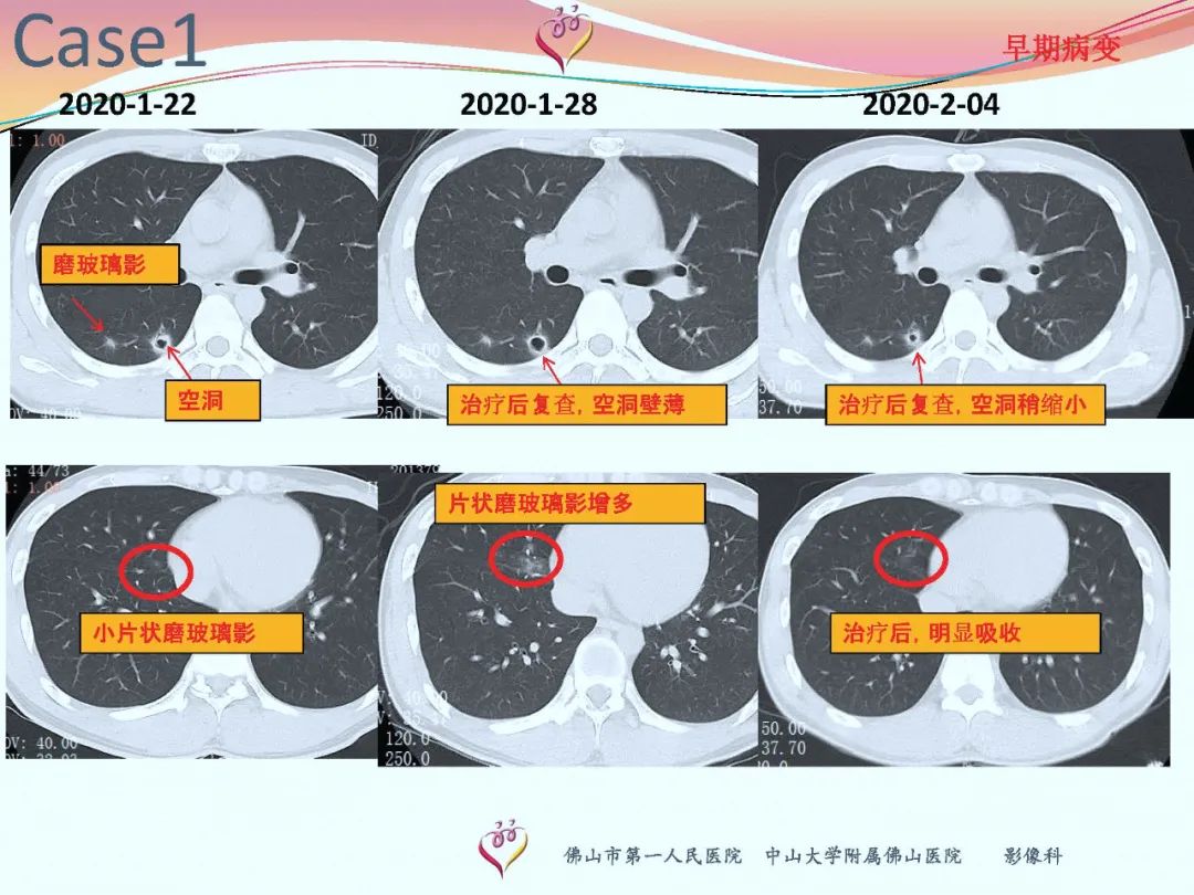 【PPT】CT室对新型冠状病毒肺炎的应对策略及影像诊断分析