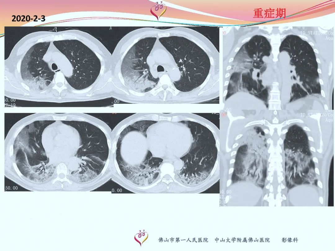 【PPT】CT室对新型冠状病毒肺炎的应对策略及影像诊断分析