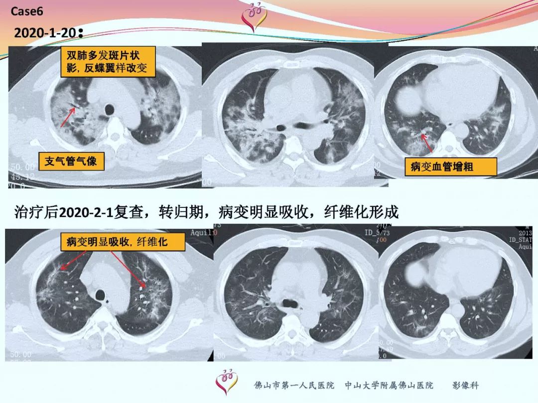 【PPT】CT室对新型冠状病毒肺炎的应对策略及影像诊断分析