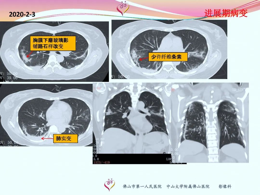 【PPT】CT室对新型冠状病毒肺炎的应对策略及影像诊断分析