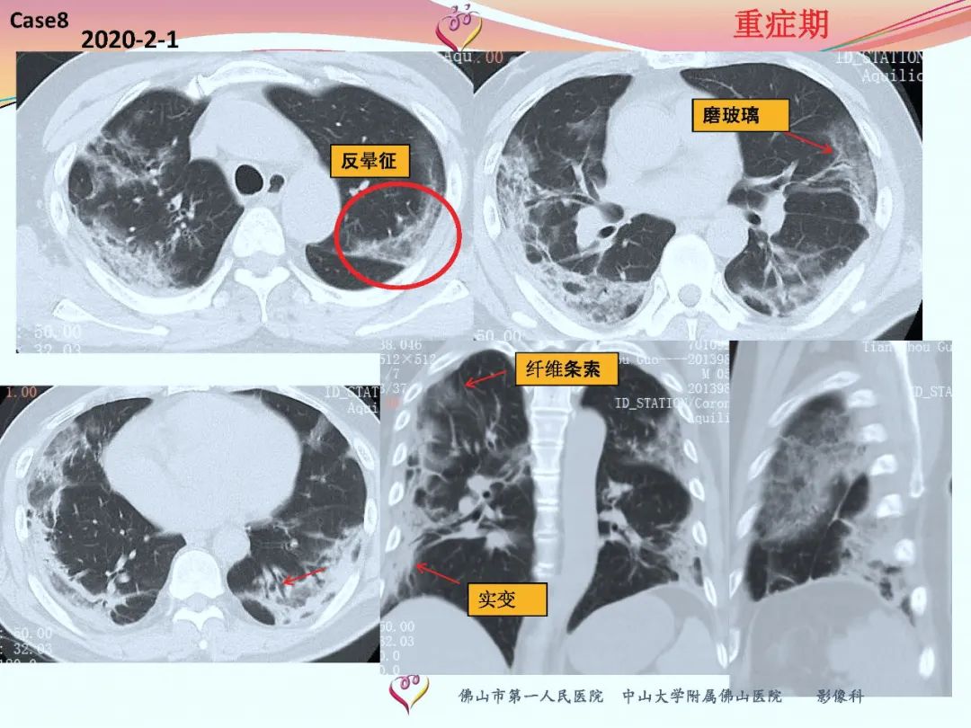【PPT】CT室对新型冠状病毒肺炎的应对策略及影像诊断分析