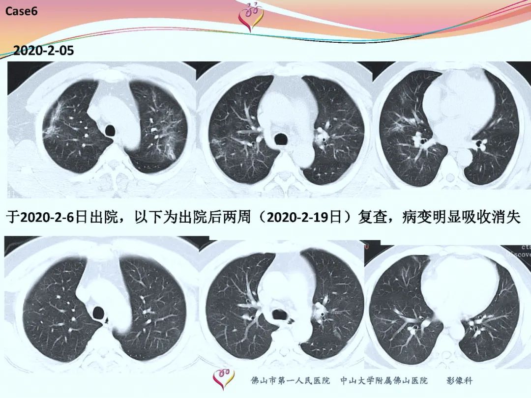 【PPT】CT室对新型冠状病毒肺炎的应对策略及影像诊断分析