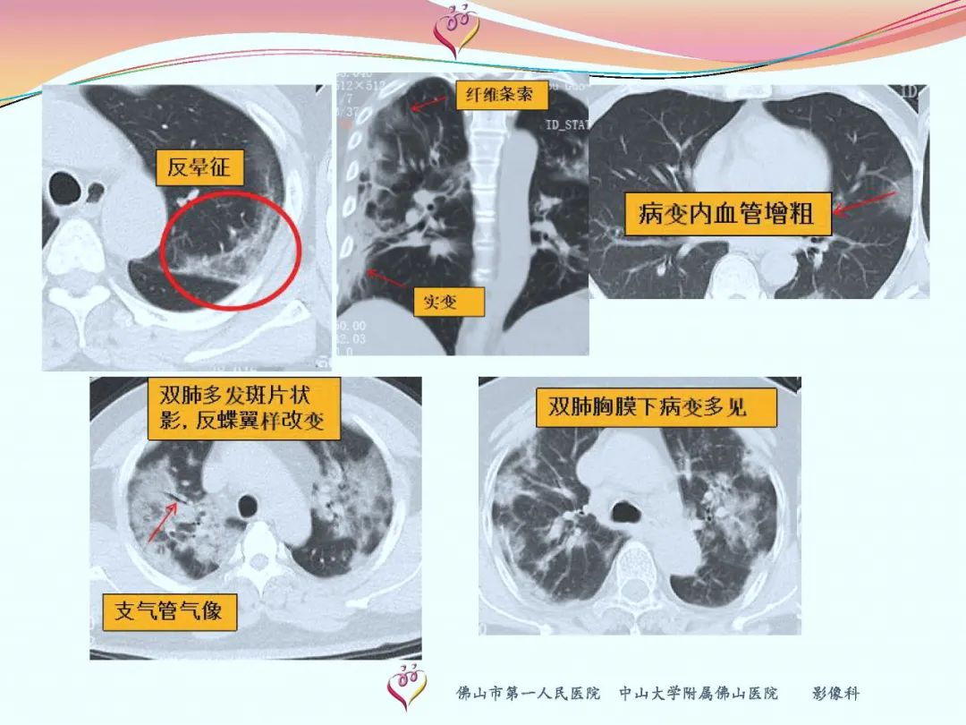 【PPT】CT室对新型冠状病毒肺炎的应对策略及影像诊断分析