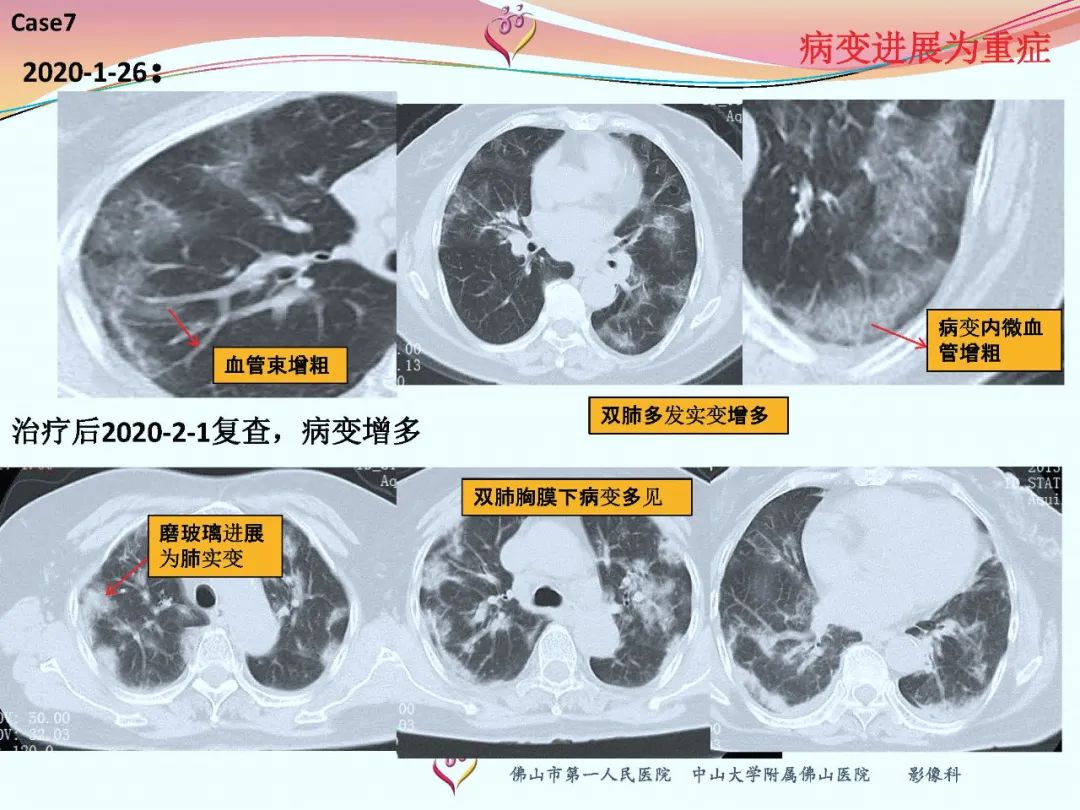 【PPT】CT室对新型冠状病毒肺炎的应对策略及影像诊断分析