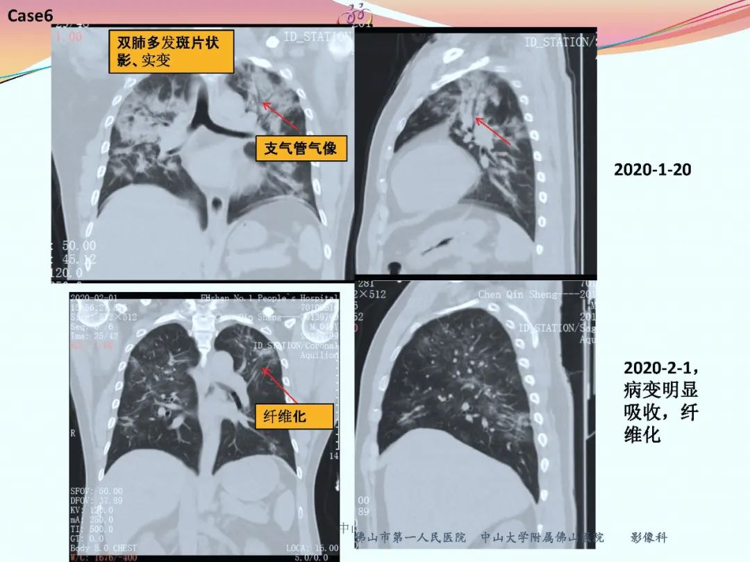 【PPT】CT室对新型冠状病毒肺炎的应对策略及影像诊断分析