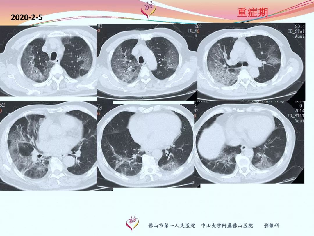 【PPT】CT室对新型冠状病毒肺炎的应对策略及影像诊断分析