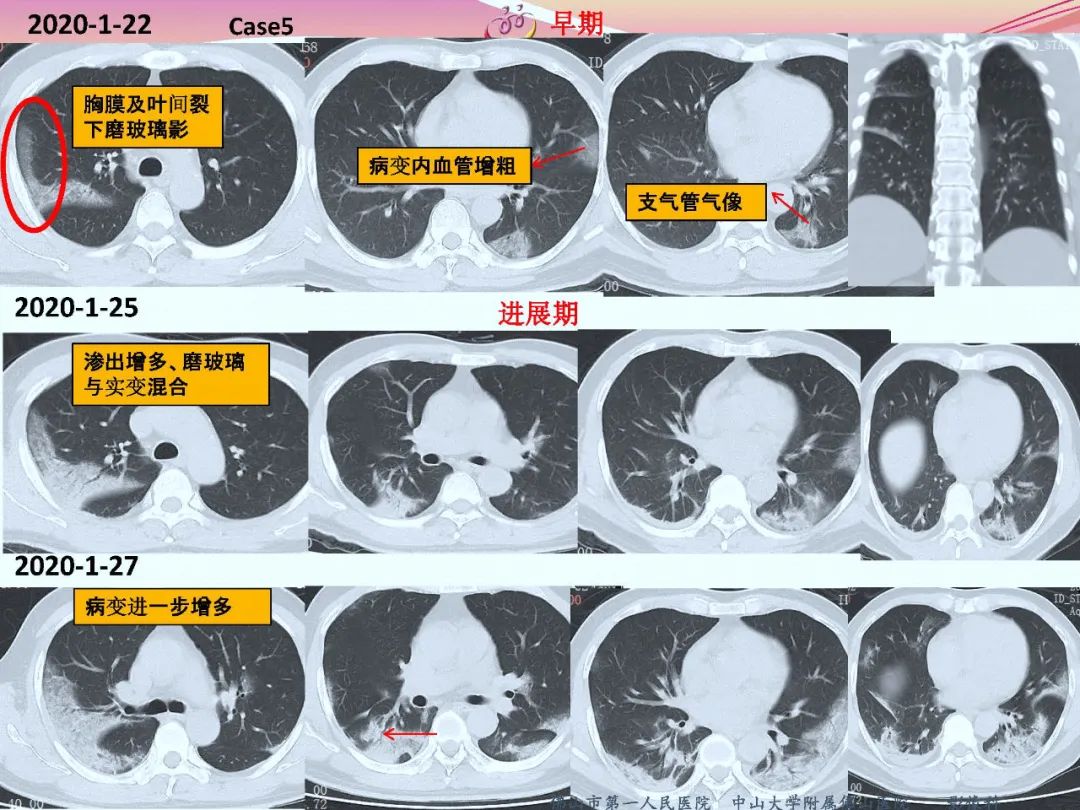 【PPT】CT室对新型冠状病毒肺炎的应对策略及影像诊断分析