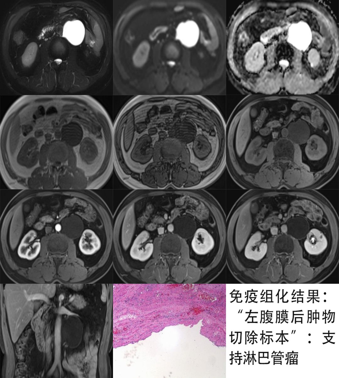 【病例】腹膜后占位1例—见缝就钻、包绕血管