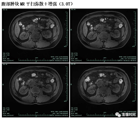 【病例】腹膜后占位1例—见缝就钻、包绕血管