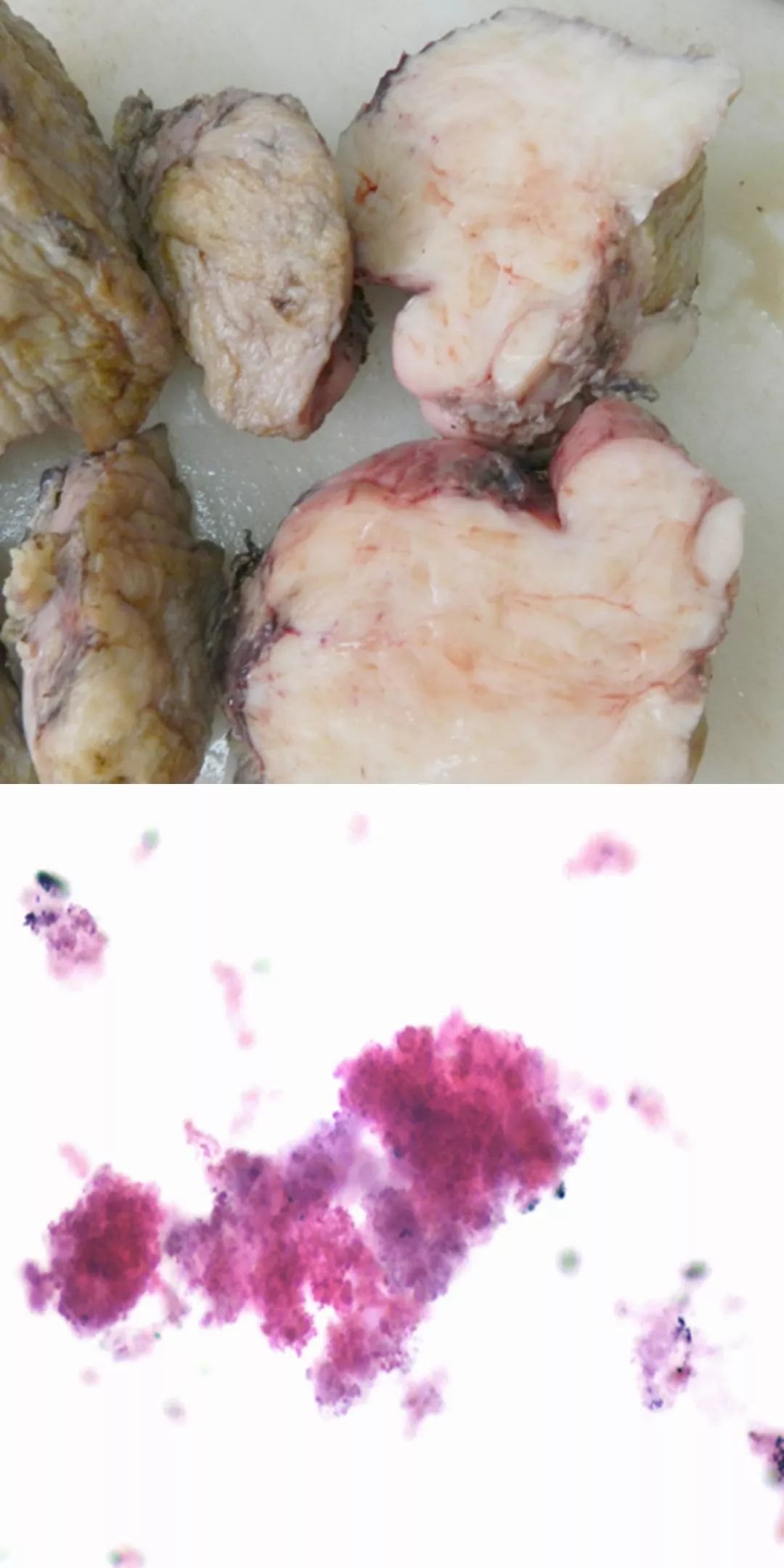 【病例】腹膜后占位1例—见缝就钻、包绕血管